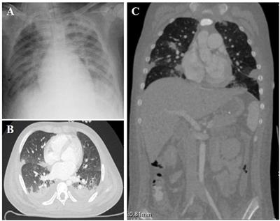 Case Report: Lessons Learned From Aortic Valve Rupture After Blunt Chest Trauma